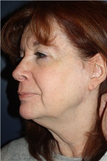 Facelift Before Photo by Larry Weinstein, MD; Chester, NJ - Case 31926