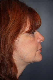 Facelift After Photo by Larry Weinstein, MD; Chester, NJ - Case 31926