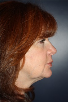 Facelift Before Photo by Larry Weinstein, MD; Chester, NJ - Case 31926