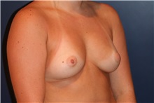 Breast Augmentation Before Photo by Larry Weinstein, MD; Chester, NJ - Case 32494