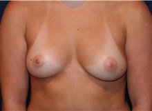 Breast Augmentation Before Photo by Larry Weinstein, MD; Chester, NJ - Case 32494