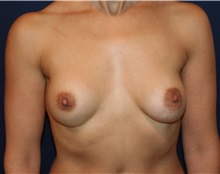 Breast Augmentation Before Photo by Larry Weinstein, MD; Chester, NJ - Case 32495