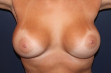 Breast Augmentation After Photo by Larry Weinstein, MD; Chester, NJ - Case 32496