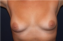 Breast Augmentation Before Photo by Larry Weinstein, MD; Chester, NJ - Case 32496