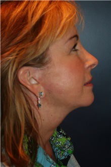 Facelift After Photo by Larry Weinstein, MD; Chester, NJ - Case 32497