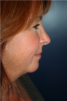 Facelift Before Photo by Larry Weinstein, MD; Chester, NJ - Case 32497