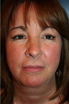 Facelift Before Photo by Larry Weinstein, MD; Chester, NJ - Case 32497