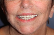 Lip Augmentation/Enhancement After Photo by Larry Weinstein, MD; Chester, NJ - Case 32499