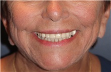 Lip Augmentation/Enhancement Before Photo by Larry Weinstein, MD; Chester, NJ - Case 32499