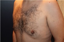 Male Breast Reduction After Photo by Larry Weinstein, MD; Chester, NJ - Case 32825