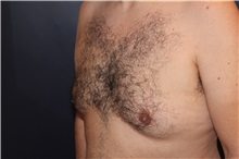 Male Breast Reduction Before Photo by Larry Weinstein, MD; Chester, NJ - Case 32825