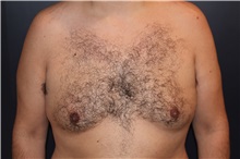 Male Breast Reduction Before Photo by Larry Weinstein, MD; Chester, NJ - Case 32825