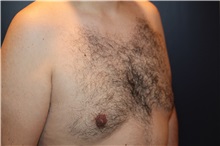 Male Breast Reduction After Photo by Larry Weinstein, MD; Chester, NJ - Case 32825