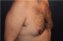 Male Breast Reduction Before Photo by Larry Weinstein, MD; Chester, NJ - Case 32825