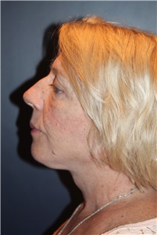 Facelift After Photo by Larry Weinstein, MD; Chester, NJ - Case 32827