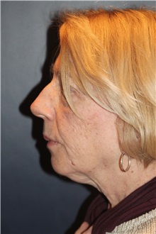 Facelift Before Photo by Larry Weinstein, MD; Chester, NJ - Case 32827