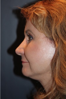 Facelift After Photo by Larry Weinstein, MD; Chester, NJ - Case 32829