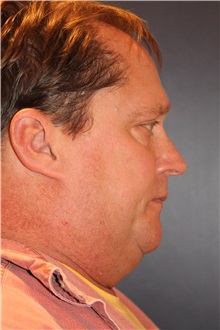 Facelift Before Photo by Larry Weinstein, MD; Chester, NJ - Case 32904