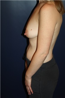 Breast Augmentation Before Photo by Larry Weinstein, MD; Chester, NJ - Case 32957