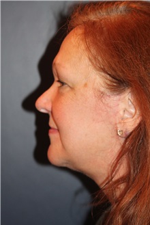 Facelift After Photo by Larry Weinstein, MD; Chester, NJ - Case 33155