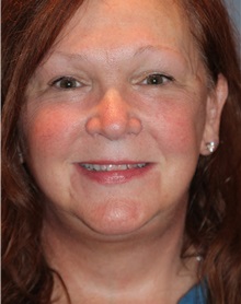 Facelift After Photo by Larry Weinstein, MD; Chester, NJ - Case 33155