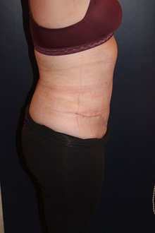 Body Contouring After Photo by Larry Weinstein, MD; Chester, NJ - Case 33668