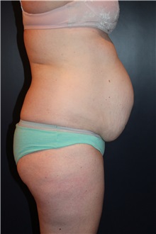 Body Contouring Before Photo by Larry Weinstein, MD; Chester, NJ - Case 33668