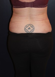 Liposuction After Photo by Larry Weinstein, MD; Chester, NJ - Case 33669