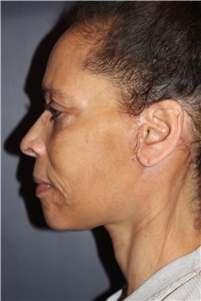 Facelift After Photo by Larry Weinstein, MD; Chester, NJ - Case 33670