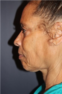 Facelift Before Photo by Larry Weinstein, MD; Chester, NJ - Case 33670