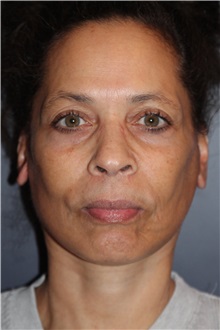 Facelift After Photo by Larry Weinstein, MD; Chester, NJ - Case 33670