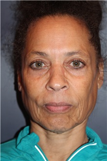 Facelift Before Photo by Larry Weinstein, MD; Chester, NJ - Case 33670