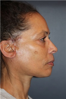 Facelift After Photo by Larry Weinstein, MD; Chester, NJ - Case 33670