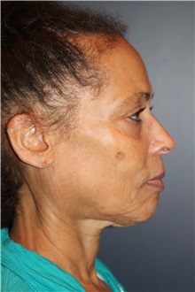 Facelift Before Photo by Larry Weinstein, MD; Chester, NJ - Case 33670