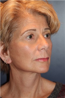 Facelift After Photo by Larry Weinstein, MD; Chester, NJ - Case 33671