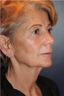 Facelift Before Photo by Larry Weinstein, MD; Chester, NJ - Case 33671