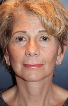 Facelift After Photo by Larry Weinstein, MD; Chester, NJ - Case 33671