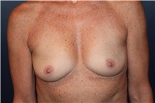 Breast Augmentation Before Photo by Larry Weinstein, MD; Chester, NJ - Case 33719