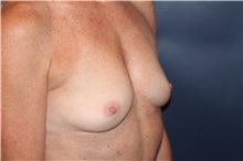 Breast Augmentation Before Photo by Larry Weinstein, MD; Chester, NJ - Case 33719