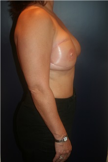 Breast Reconstruction After Photo by Larry Weinstein, MD; Chester, NJ - Case 33971