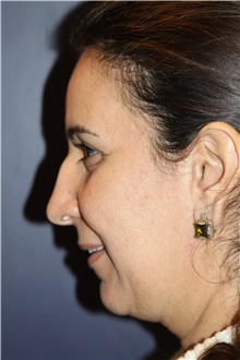 Chin Augmentation Before Photo by Larry Weinstein, MD; Chester, NJ - Case 34127