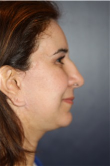 Chin Augmentation After Photo by Larry Weinstein, MD; Chester, NJ - Case 34128