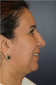 Chin Augmentation Before Photo by Larry Weinstein, MD; Chester, NJ - Case 34128