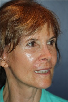 Facelift After Photo by Larry Weinstein, MD; Chester, NJ - Case 34630