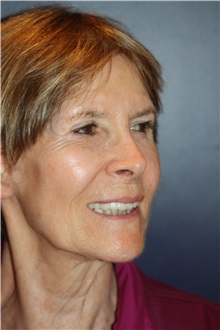 Facelift Before Photo by Larry Weinstein, MD; Chester, NJ - Case 34630
