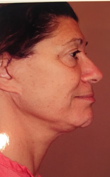 Facelift Before Photo by Larry Weinstein, MD; Chester, NJ - Case 34827