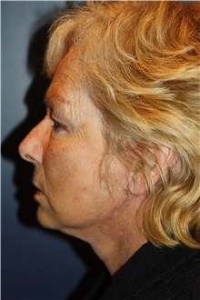 Facelift After Photo by Larry Weinstein, MD; Chester, NJ - Case 35845