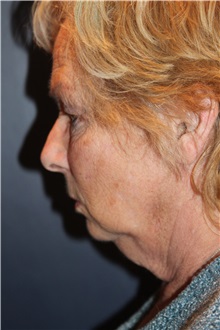 Facelift Before Photo by Larry Weinstein, MD; Chester, NJ - Case 35845