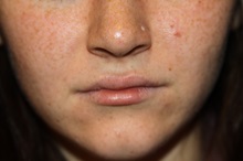 Lip Augmentation/Enhancement After Photo by Larry Weinstein, MD; Chester, NJ - Case 37441