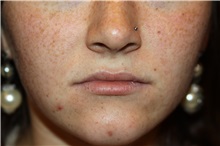 Lip Augmentation/Enhancement Before Photo by Larry Weinstein, MD; Chester, NJ - Case 37441